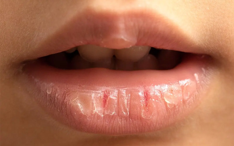 دلیل خشک شدن و ترک لب چیست؟